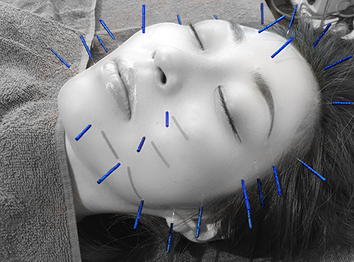 美容鍼